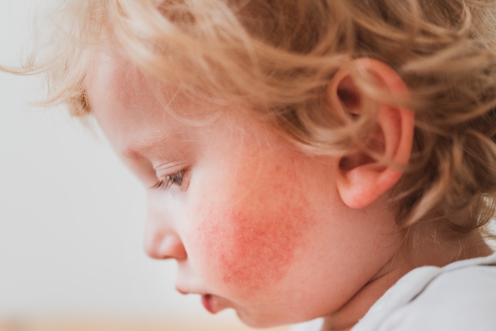 Skin Rashes and Eczema in Children